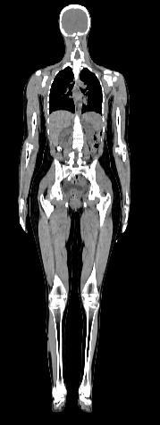 A whole body CT-scan can detect cancer anywhere in the body.